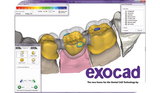 A bridge being designed in exocad CAD software