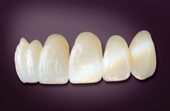 Zirconia bridge with natural translucency